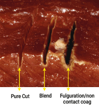 Elektrokoter operasyonunda argon plazma katmanı
